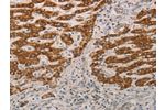 The image on the left is immunohistochemistry of paraffin-embedded Human liver cancer tissue using CSB-PA480938(AIFM1 Antibody) at dilution 1/15, on the right is treated with fusion protein. (Original magnification: 
