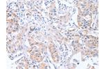 The image on the left is immunohistochemistry of paraffin-embedded Human lung cancer tissue using CSB-PA497239(CDCA4 Antibody) at dilution 1/50, on the right is treated with synthetic peptide. (Original magnification: 