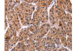 The image on the left is immunohistochemistry of paraffin-embedded Human liver cancer tissue using CSB-PA498240(EFNA5 Antibody) at dilution 1/40, on the right is treated with synthetic peptide. (Original magnification: 