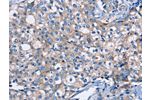 The image on the left is immunohistochemistry of paraffin-embedded Human breast cancer tissue using CSB-PA503789(DMD Antibody) at dilution 1/30, on the right is treated with fusion protein. (Original magnification: 