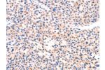 The image on the left is immunohistochemistry of paraffin-embedded Human liver cancer tissue using CSB-PA504012(APBA2 Antibody) at dilution 1/80, on the right is treated with synthetic peptide. (Original magnification: 