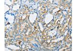 The image on the left is immunohistochemistry of paraffin-embedded Human thyroid cancer tissue using CSB-PA514644(ARSA Antibody) at dilution 1/50, on the right is treated with fusion protein. (Original magnification: 