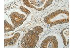 The image on the left is immunohistochemistry of paraffin-embedded Human colon cancer tissue using CSB-PA516472(CCND1 Antibody) at dilution 1/50, on the right is treated with fusion protein. (Original magnification: 