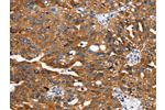The image on the left is immunohistochemistry of paraffin-embedded Human breast cancer tissue using CSB-PA519093(EGLN1 Antibody) at dilution 1/25, on the right is treated with fusion protein. (Original magnification: 