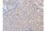 The image on the left is immunohistochemistry of paraffin-embedded Human cervical cancer tissue using CSB-PA521729(AADACL2 Antibody) at dilution 1/25, on the right is treated with fusion protein. (Original magnification: 