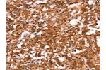 The image on the left is immunohistochemistry of paraffin-embedded Human thyroid cancer tissue using CSB-PA522630(GABRA1 Antibody) at dilution 1/30, on the right is treated with synthetic peptide. (Original magnification: 