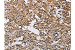 The image on the left is immunohistochemistry of paraffin-embedded Human thyroid cancer tissue using CSB-PA522891(DNMT3A Antibody) at dilution 1/50, on the right is treated with fusion protein. (Original magnification: 