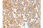The image on the left is immunohistochemistry of paraffin-embedded Human thyroid cancer tissue using CSB-PA524180(EPS15L1 Antibody) at dilution 1/30, on the right is treated with fusion protein. (Original magnification: 