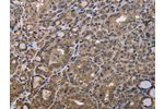 The image is immunohistochemistry of paraffin-embedded Human thyroid cancer tissue using CSB-PA526376(GADD45B Antibody) at dilution 1/40. (Original magnification: 