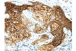 The image on the left is immunohistochemistry of paraffin-embedded Human cervical cancer tissue using CSB-PA531552(AQP3 Antibody) at dilution 1/30, on the right is treated with synthetic peptide. (Original magnification: 