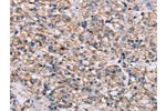 The image on the left is immunohistochemistry of paraffin-embedded Human prostate cancer tissue using CSB-PA533274(ADAM12 Antibody) at dilution 1/40, on the right is treated with synthetic peptide. (Original magnification: 