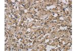 The image on the left is immunohistochemistry of paraffin-embedded Human thyroid cancer tissue using CSB-PA542036(DCN Antibody) at dilution 1/30, on the right is treated with fusion protein. (Original magnification: 
