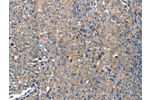 The image on the left is immunohistochemistry of paraffin-embedded Human ovarian cancer tissue using CSB-PA546791(DEFA1 Antibody) at dilution 1/10, on the right is treated with fusion protein. (Original magnification: 