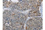 The image on the left is immunohistochemistry of paraffin-embedded Human liver cancer tissue using CSB-PA547032(ATG4A Antibody) at dilution 1/30, on the right is treated with synthetic peptide. (Original magnification: 