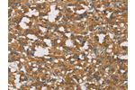 The image on the left is immunohistochemistry of paraffin-embedded Human thyroid cancer tissue using CSB-PA547632(DCTN1 Antibody) at dilution 1/50, on the right is treated with fusion protein. (Original magnification: 
