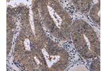 The image on the left is immunohistochemistry of paraffin-embedded Human colon cancer tissue using CSB-PA547925(CDK5 Antibody) at dilution 1/30, on the right is treated with fusion protein. (Original magnification: 