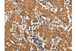 The image on the left is immunohistochemistry of paraffin-embedded Human gastic cancer tissue using CSB-PA548176(EPPIN Antibody) at dilution 1/25, on the right is treated with synthetic peptide. (Original magnification: 