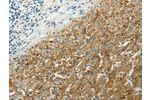 The image on the left is immunohistochemistry of paraffin-embedded Human liver cancer tissue using CSB-PA548368(SLC16A1 Antibody) at dilution 1/50, on the right is treated with synthetic peptide. (Original magnification: 