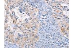 The image on the left is immunohistochemistry of paraffin-embedded Human cervical cancer tissue using CSB-PA548882(CCR5 Antibody) at dilution 1/15, on the right is treated with synthetic peptide. (Original magnification: 