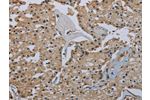 The image on the left is immunohistochemistry of paraffin-embedded Human prostate cancer tissue using CSB-PA549292(FLCN Antibody) at dilution 1/40, on the right is treated with fusion protein. (Original magnification: 