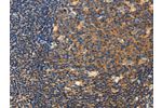 The image on the left is immunohistochemistry of paraffin-embedded Human tonsil tissue using CSB-PA549396(CERK Antibody) at dilution 1/50, on the right is treated with fusion protein. (Original magnification: 