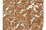The image on the left is immunohistochemistry of paraffin-embedded Human liver cancer tissue using CSB-PA549792(DOPEY1 Antibody) at dilution 1/25, on the right is treated with synthetic peptide. (Original magnification: 