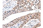The image on the left is immunohistochemistry of paraffin-embedded Human esophagus cancer tissue using CSB-PA549840(GJB2 Antibody) at dilution 1/100, on the right is treated with synthetic peptide. (Original magnification: 