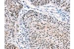 The image on the left is immunohistochemistry of paraffin-embedded Human ovarian cancer tissue using CSB-PA549967(CTBP2 Antibody) at dilution 1/40, on the right is treated with synthetic peptide. (Original magnification: 