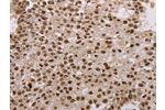 The image on the left is immunohistochemistry of paraffin-embedded Human breast cancer tissue using CSB-PA550074(AKAP8L Antibody) at dilution 1/15, on the right is treated with fusion protein. (Original magnification: 