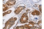 The image on the left is immunohistochemistry of paraffin-embedded Human colon cancer tissue using CSB-PA550152(CA9 Antibody) at dilution 1/40, on the right is treated with fusion protein. (Original magnification: 