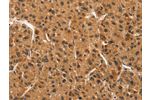 The image on the left is immunohistochemistry of paraffin-embedded Human liver cancer tissue using CSB-PA550437(CCNT1 Antibody) at dilution 1/30, on the right is treated with synthetic peptide. (Original magnification: 
