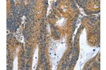 The image on the left is immunohistochemistry of paraffin-embedded Human colon cancer tissue using CSB-PA550582(ANAPC10 Antibody) at dilution 1/30, on the right is treated with fusion protein. (Original magnification: 