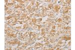 The image on the left is immunohistochemistry of paraffin-embedded Human thyroid cancer tissue using CSB-PA551903(AES Antibody) at dilution 1/20, on the right is treated with fusion protein. (Original magnification: 