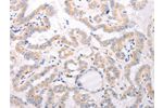 The image on the left is immunohistochemistry of paraffin-embedded Human thyroid cancer tissue using CSB-PA552167(CIDEB Antibody) at dilution 1/50, on the right is treated with fusion protein. (Original magnification: 