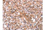 The image on the left is immunohistochemistry of paraffin-embedded Human thyroid cancer tissue using CSB-PA552207(BCR Antibody) at dilution 1/15, on the right is treated with synthetic peptide. (Original magnification: 