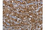 The image on the left is immunohistochemistry of paraffin-embedded Human breast cancer tissue using CSB-PA552215(GCK Antibody) at dilution 1/60, on the right is treated with fusion protein. (Original magnification: 