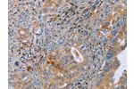 The image on the left is immunohistochemistry of paraffin-embedded Human cervical cancer tissue using CSB-PA552403(GMFG Antibody) at dilution 1/50, on the right is treated with fusion protein. (Original magnification: 