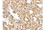The image on the left is immunohistochemistry of paraffin-embedded Human thyroid cancer tissue using CSB-PA552720(APTX Antibody) at dilution 1/50, on the right is treated with fusion protein. (Original magnification: 