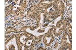 The image on the left is immunohistochemistry of paraffin-embedded Human gastic cancer tissue using CSB-PA553324(CENPV Antibody) at dilution 1/30, on the right is treated with synthetic peptide. (Original magnification: 