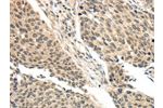 The image on the left is immunohistochemistry of paraffin-embedded Human lung cancer tissue using CSB-PA553405(BRCA2 Antibody) at dilution 1/35, on the right is treated with synthetic peptide. (Original magnification: 