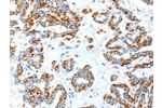 The image on the left is immunohistochemistry of paraffin-embedded Human thyroid cancer tissue using CSB-PA553471(ALDH5A1 Antibody) at dilution 1/35, on the right is treated with synthetic peptide. (Original magnification: 