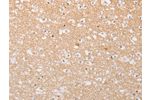 The image on the left is immunohistochemistry of paraffin-embedded Human brain tissue using CSB-PA554014(ATG9A Antibody) at dilution 1/30, on the right is treated with fusion protein. (Original magnification: 