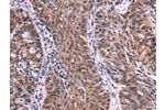 The image on the left is immunohistochemistry of paraffin-embedded Human ovarian cancer tissue using CSB-PA554018(EIF2AK4 Antibody) at dilution 1/50, on the right is treated with fusion protein. (Original magnification: 