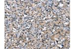 The image on the left is immunohistochemistry of paraffin-embedded Human thyroid cancer tissue using CSB-PA554127(DDR2 Antibody) at dilution 1/40, on the right is treated with synthetic peptide. (Original magnification: 