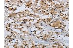 The image on the left is immunohistochemistry of paraffin-embedded Human thyroid cancer tissue using CSB-PA554166(CMTM8 Antibody) at dilution 1/40, on the right is treated with synthetic peptide. (Original magnification: 