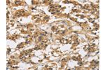 The image is immunohistochemistry of paraffin-embedded Human thyroid cancer tissue using CSB-PA554215(GAS7 Antibody) at dilution 1/50. (Original magnification: 