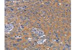 The image on the left is immunohistochemistry of paraffin-embedded Human cervical cancer tissue using CSB-PA554403(BOD1 Antibody) at dilution 1/60, on the right is treated with synthetic peptide. (Original magnification: 