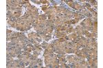 The image on the left is immunohistochemistry of paraffin-embedded Human liver cancer tissue using CSB-PA554695(ACTN2 Antibody) at dilution 1/30, on the right is treated with synthetic peptide. (Original magnification: 