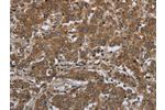 The image on the left is immunohistochemistry of paraffin-embedded Human liver cancer tissue using CSB-PA554723(GABRB1 Antibody) at dilution 1/50, on the right is treated with fusion protein. (Original magnification: 