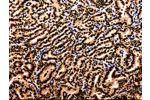 The image on the left is immunohistochemistry of paraffin-embedded Human thyroid cancer tissue using CSB-PA555100(APIP Antibody) at dilution 1/10, on the right is treated with fusion protein. (Original magnification: 